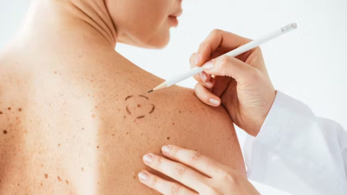 As vacinas contra o melanoma estão chegando: como funcionam?